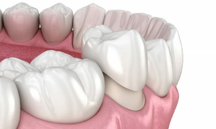 Bọc răng sứ là biện pháp khắc phục hiệu quả cho những người bị mòn chân răng