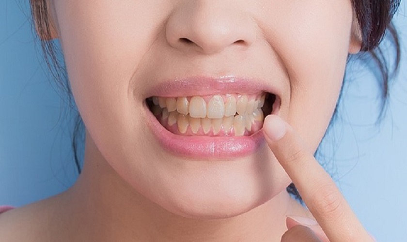 Ố vàng răng do nhiễm kháng sinh