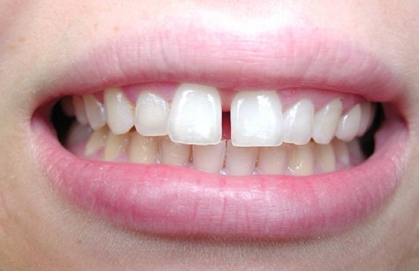 Tình trạng răng cửa mọc thưa