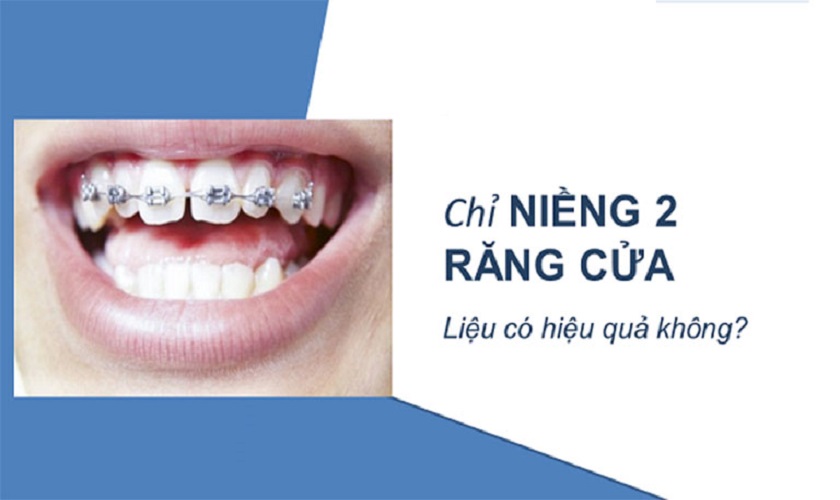 Chỉ niềng 2 răng cửa được không?