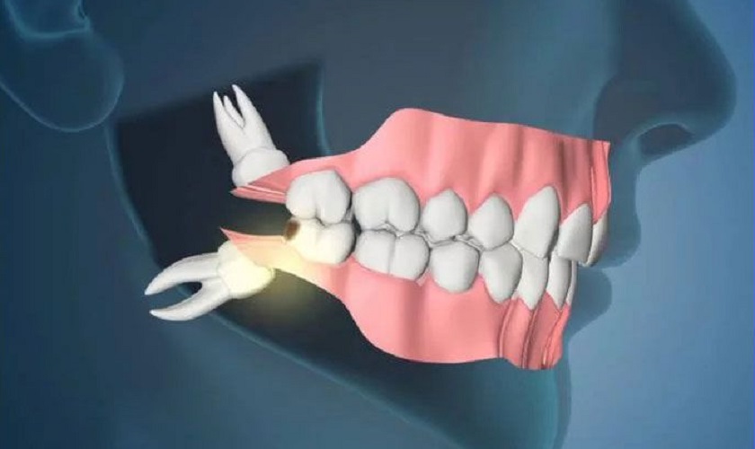 Răng khôn thường xuyên mọc lệch gây ảnh hưởng tới sức khỏe