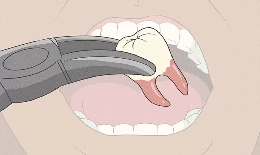 Chi phí nhổ răng số 8 là bao nhiêu?