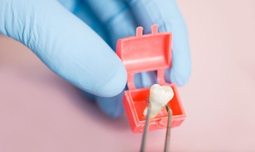 Cập nhật chi phí nhổ răng số 8 mới nhất