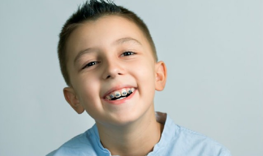 Niềng răng trẻ em