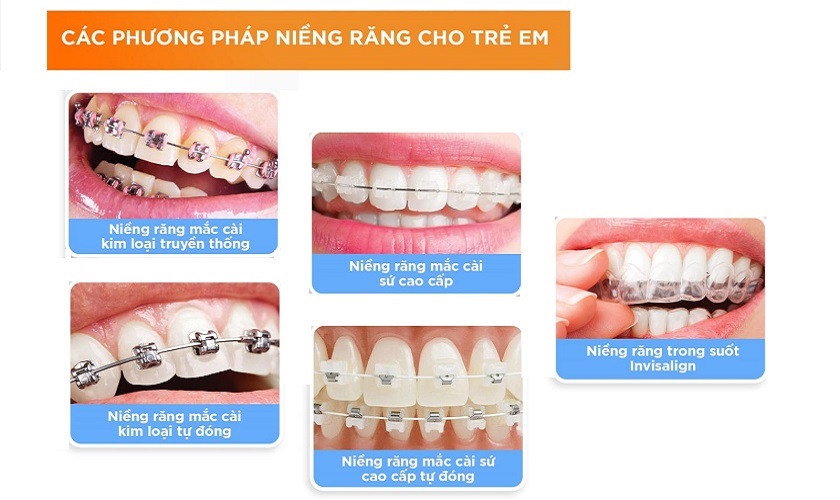 Phương pháp niềng cũng quyết định chi phí niềng răng