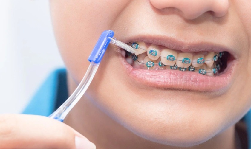 Bàn chải kẽ răng chữ L