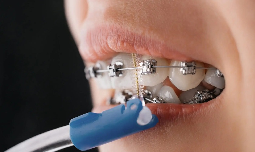 Bàn chải kẽ răng giúp làm sạch sâu các kẽ răng