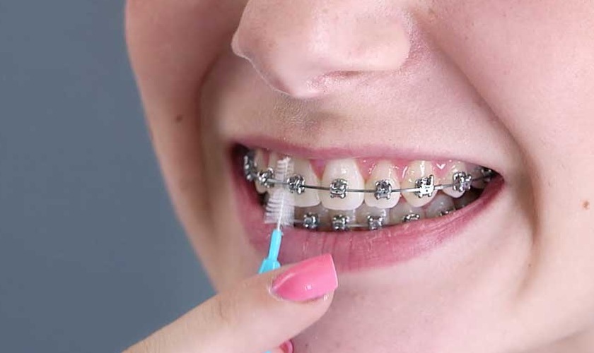 Bàn chải kẽ răng giúp giảm tình trạng ố vàng của các khí cụ niềng răng