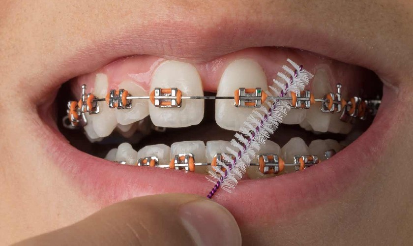 Sử dụng bàn chải kẽ răng đúng cách sẽ tăng hiệu quả làm sạch