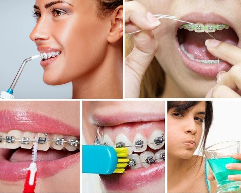 Kết hợp bàn chải kẽ với các dụng cụ vệ sinh răng miệng khác