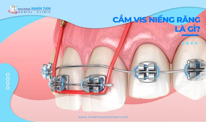 Cắm vis niềng răng là gì? Khi nào cần cắm vis?