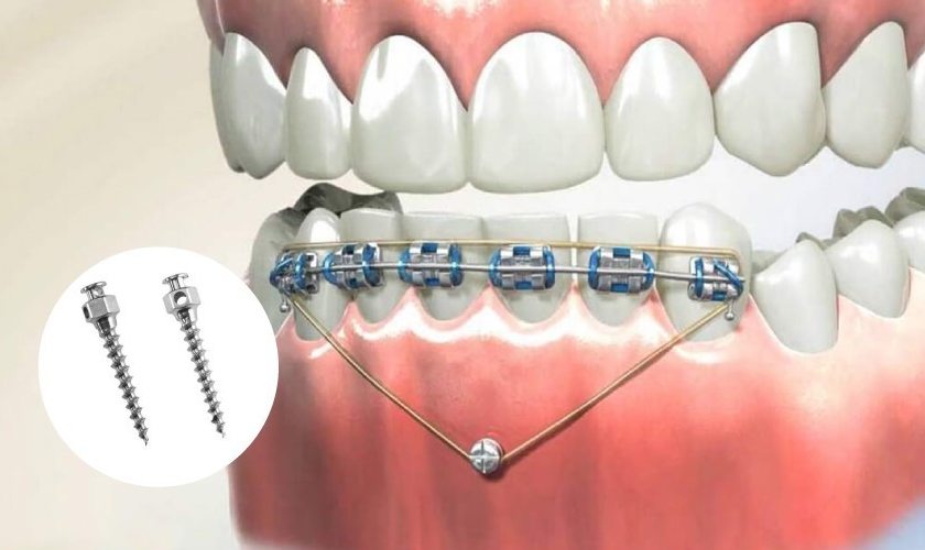 Cắm vis niềng răng là quá trình bác sĩ sẽ đặt minivis vào xương hàm, nhằm tạo điểm neo chặn cố định để kiểm soát tốt lực kéo