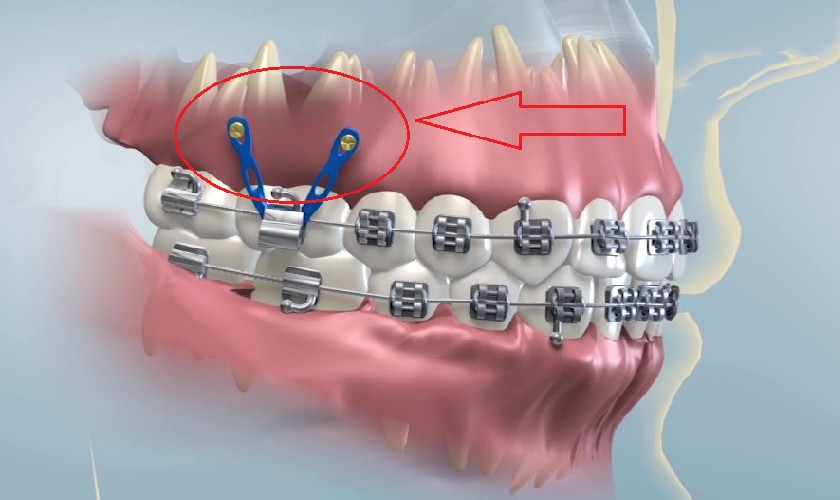 Cắm vis niềng răng được chỉ định trong những trường hợp cần thiết