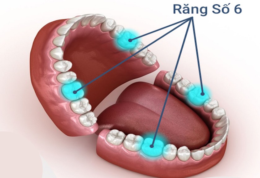 Mất răng số 6 bác sĩ có thể chỉ định cắm vis niềng răng