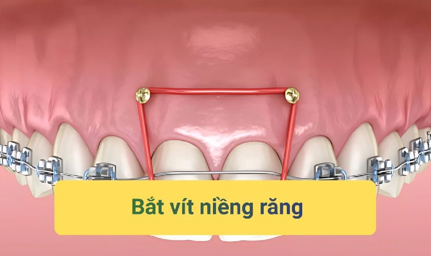 Cắm vis bao lâu thì tháo phụ thuộc vào từng trường hợp cụ thể