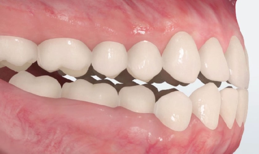 Khớp cắn đối đầu gây mất thẩm mỹ nụ cười