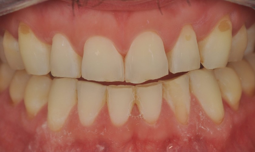 Men răng bị bào mòn