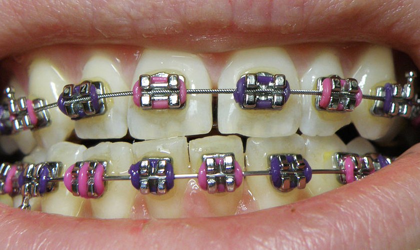 Niềng răng khắc phục khớp cắn đối đầu