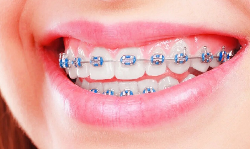 Niềng răng giúp răng đều đẹp, chuẩn khớp cắn