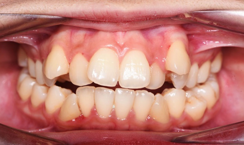 Những tác hại khi răng mọc lệch lạc
