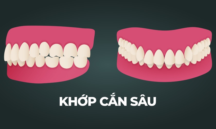 Khớp cắn sâu là tình trạng răng hàm trên bao phủ răng hàm dưới hơn 4mm trở lên