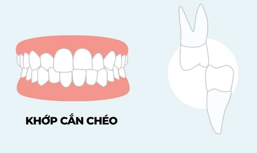 Khớp cắn chéo là tình trạng răng bị xô lệch, không đối xứng nhau