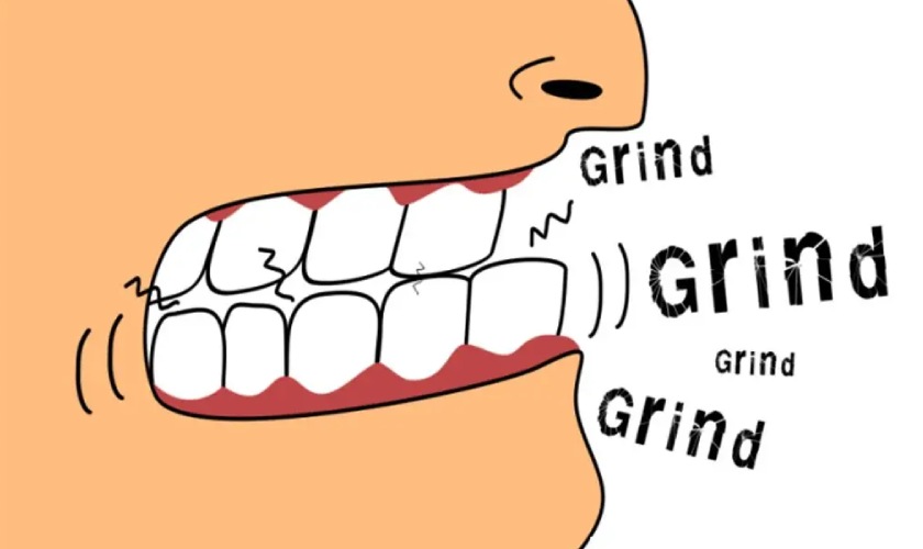 Người hay nghiến răng có thể cần thực hiện nâng khớp cắn