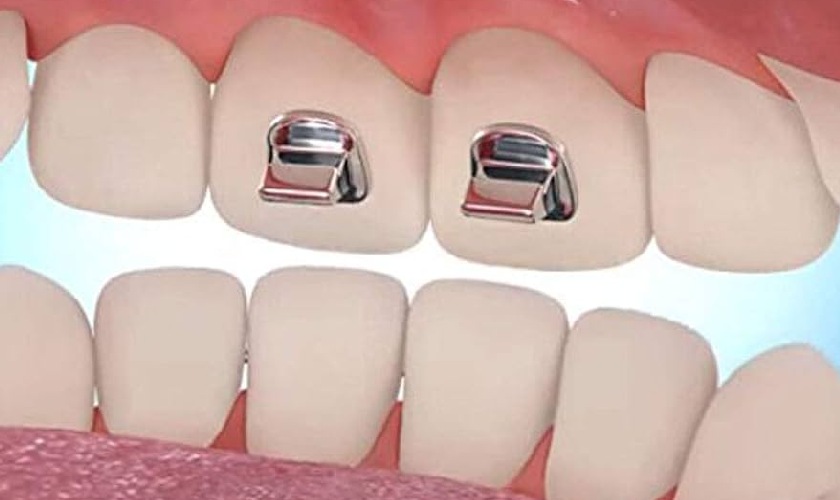 Cục nâng khớp cắn thường được gắn vào mặt sau của răng cửa