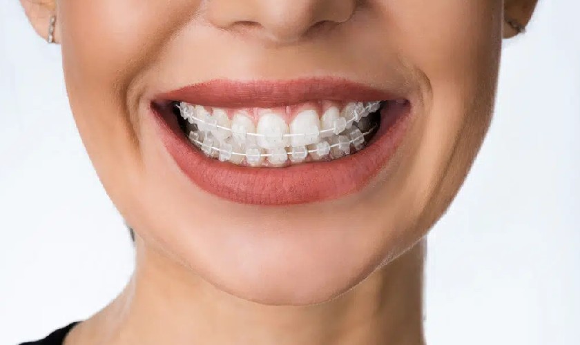 Khi đã quen với khí cụ trong miệng, bạn sẽ không cảm thấy khó chịu