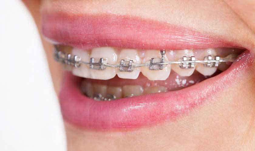 Niềng răng hô vẩu