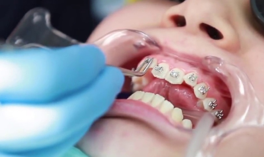 Răng đều đẹp thì tháo mắc cài Răng đều đẹp thì tháo mắc cài