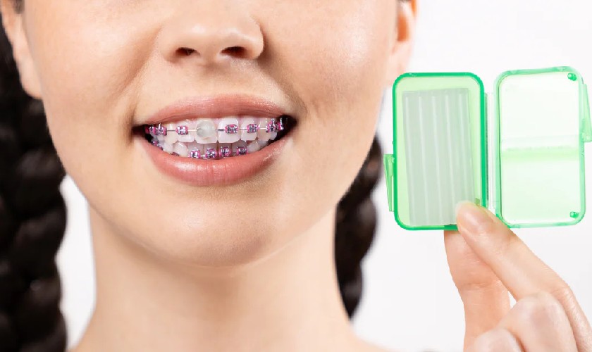 Sáp nha khoa giúp hạn chế những tổn thương do dây cung, mắc cài gây ra