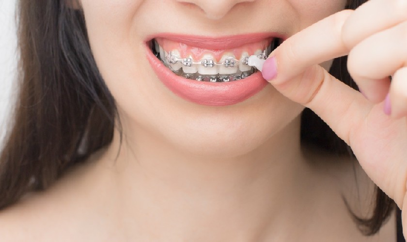 Sử dụng sáp nha khoa đúng cách để phát huy tác dụng