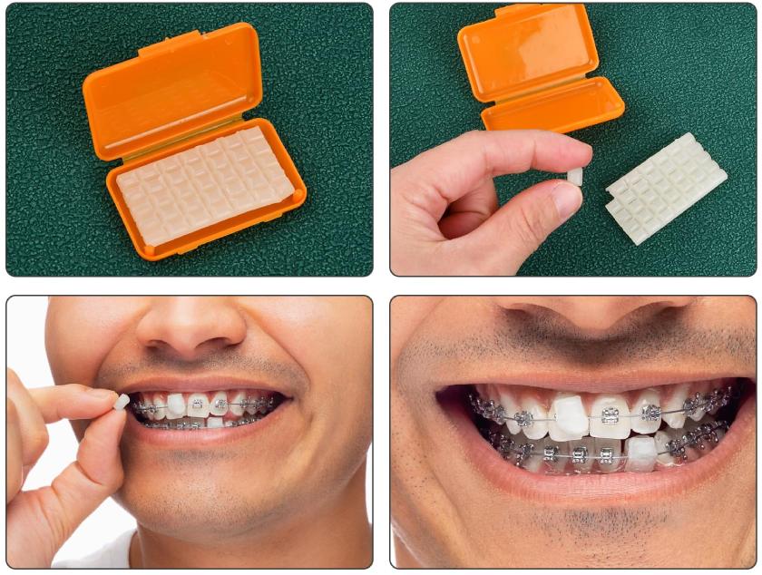 Cần lưu ý khi sử dụng sáp nha khoa