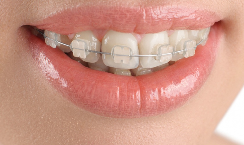 Niềng răng mắc cài sứ không gây kích ứng và hạn chế vướng víu cho người dùng