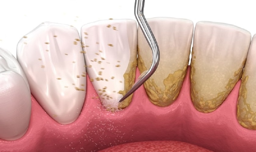 Nên cạo vôi răng định kỳ tại nha khoa để bảo vệ sức khỏe răng miệng