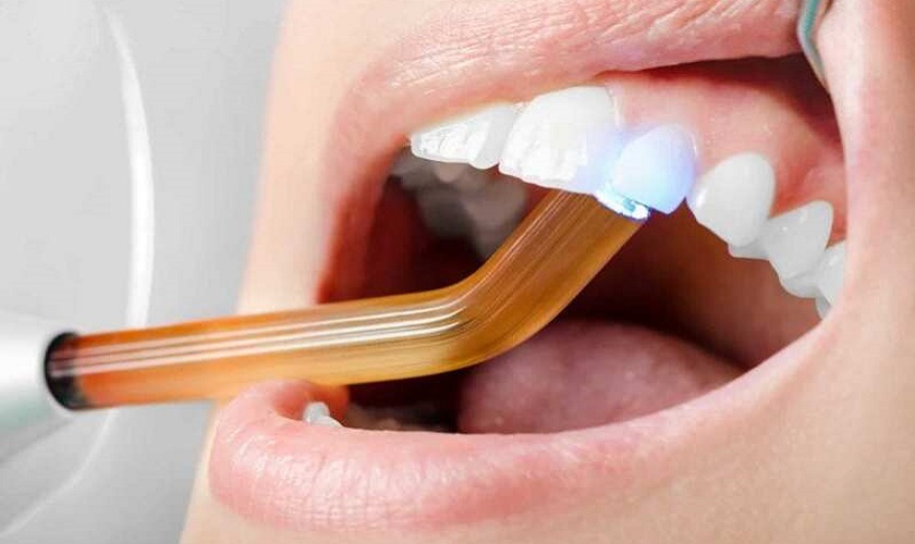 Trám bít ống tủy sau điều trị