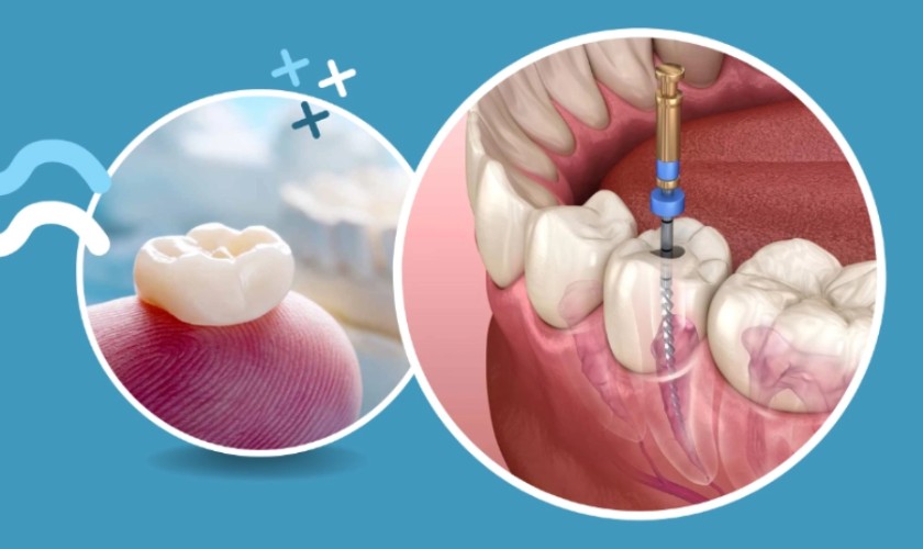 Hình: Một số cách giảm đau răng sau khi lấy tủy hiệu quả