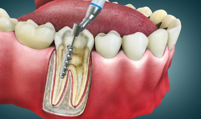 Kỹ thuật lấy tủy răng