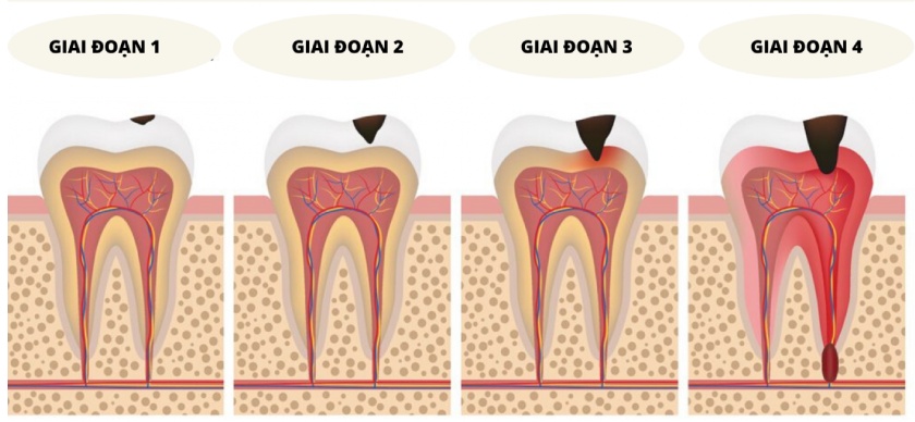 Chữa tủy răng bao nhiêu tiền còn tùy vào mức độ viêm nhiễm của tủy