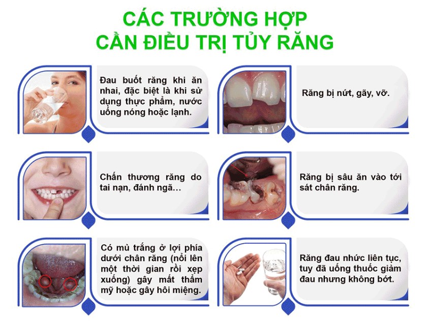 Những trường hợp cần điều trị tủy răng