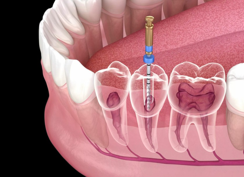 Giá lấy tủy răng sẽ khác nhau ở mỗi vị trí răng