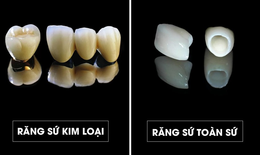 Răng toàn sứ có giá cao hơn răng sứ kim loại