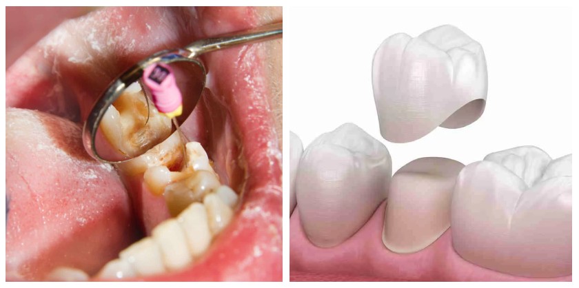 Lấy tủy bọc răng sứ giúp bảo tồn răng thật