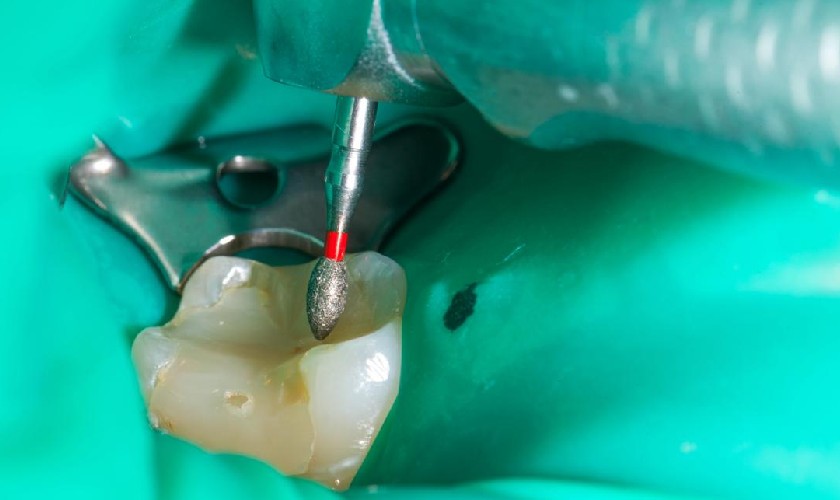 Quá trình lấy tủy răng không gây đau nhức