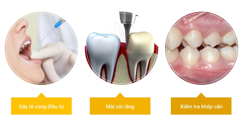 Bọc răng sứ sẽ được gây tê trước khi thực hiện