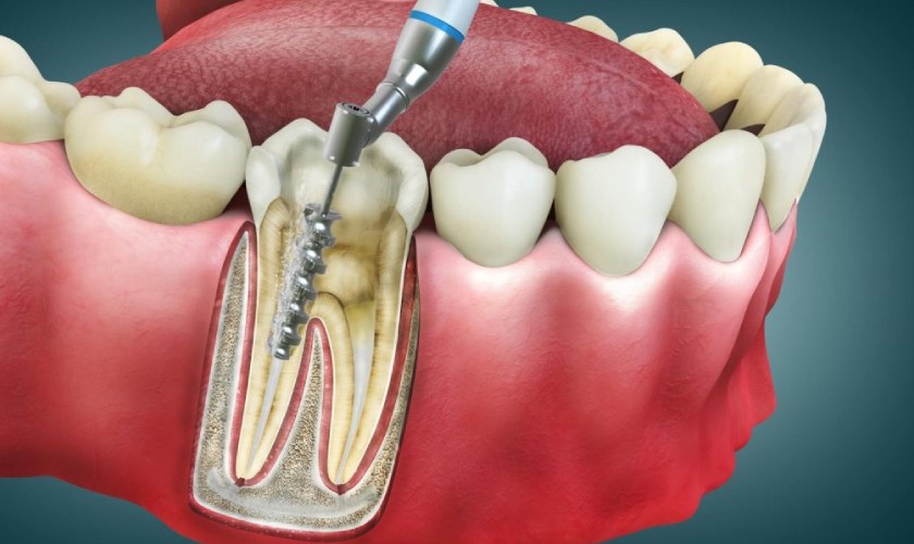 Lấy tủy răng xong có đau không? Những điều cần biết