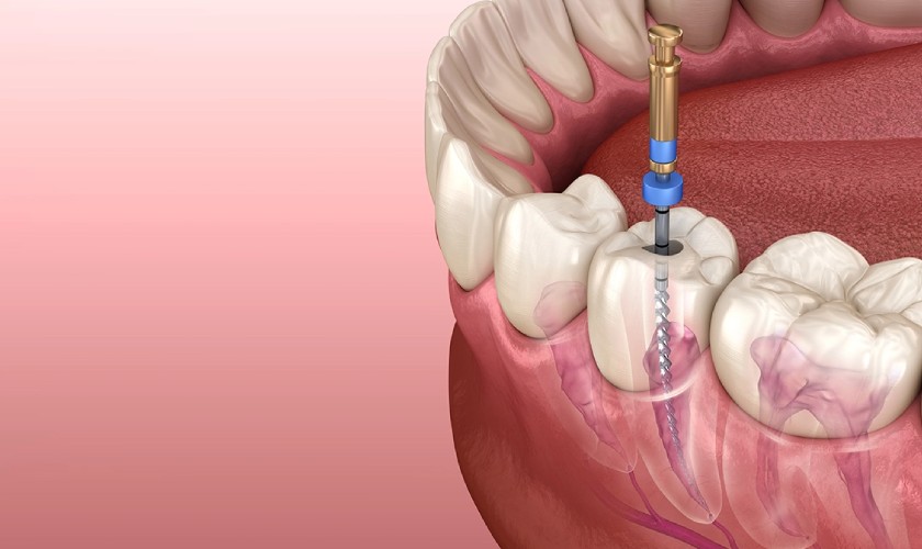 Phương pháp lấy tủy răng