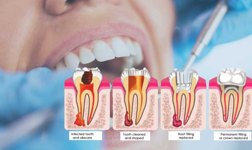 Quy trình lấy tủy răng theo tiêu chuẩn quốc tế tại Nhân Tâm