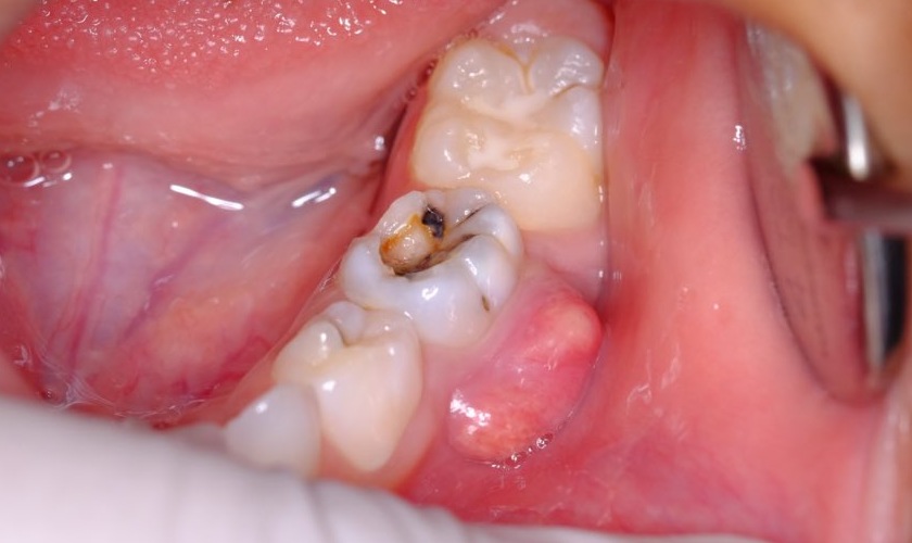 Tủy răng bị viêm nếu không được điều trị có thể hình thành áp xe răng